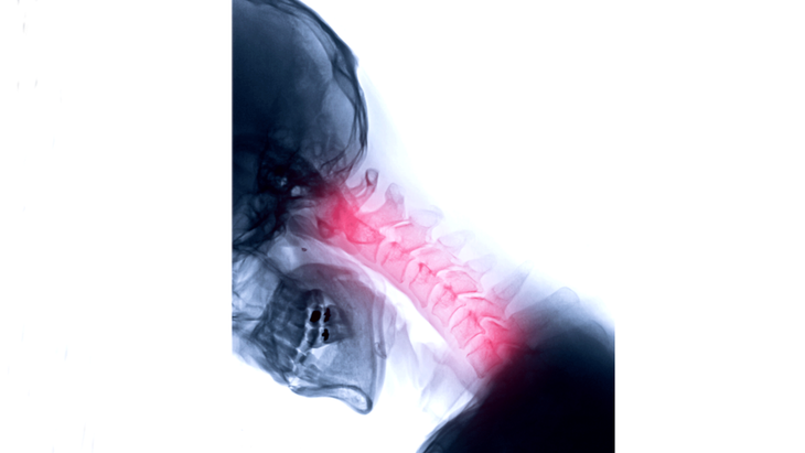 An x-ray of the cervical spine of someone with tech neck who needs to practice neck stretches for relief